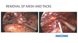 REMOVAL OF MESH AND TACKS
TACK
 