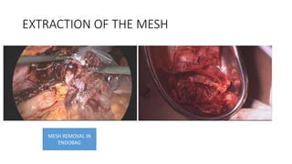 EXTRACTION OF THE MESH
MESH REMOVAL IN
ENDOBAG
 