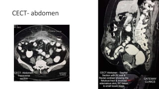 CECT- abdomen
 