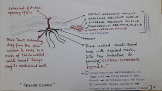 Latest in Laparoscopic Hernia surgery