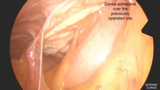 Latest in Laparoscopic Hernia surgery