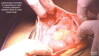 Latest in Laparoscopic Hernia surgery