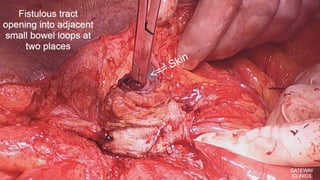 Latest in Laparoscopic Hernia surgery
