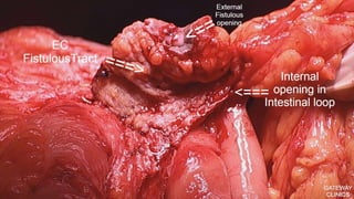 Latest in Laparoscopic Hernia surgery
