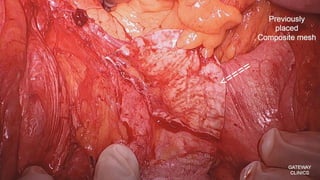 Latest in Laparoscopic Hernia surgery