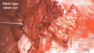 Latest in Laparoscopic Hernia surgery