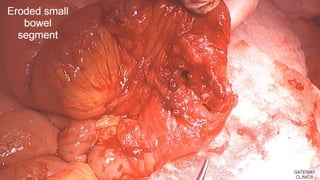 Latest in Laparoscopic Hernia surgery
