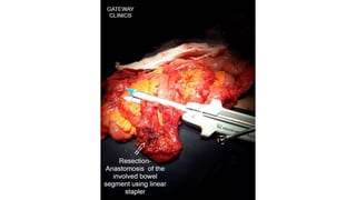 Latest in Laparoscopic Hernia surgery