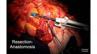Latest in Laparoscopic Hernia surgery