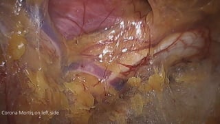 Corona Mortis on left side
 