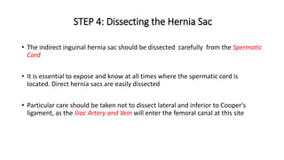 STEP 4: Dissecting the Hernia Sac
• The indirect inguinal hernia sac should be dissected carefully from the Spermatic
Cord
• It is essential to expose and know at all times where the spermatic cord is
located. Direct hernia sacs are easily dissected
• Particular care should be taken not to dissect lateral and inferior to Cooper's
ligament, as the Iliac Artery and Vein will enter the femoral canal at this site
 