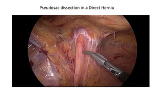 Pseudosac dissection in a Direct Hernia
 