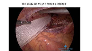 The 15X12 cm Mesh is folded & inserted
 