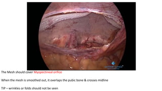 The Mesh should cover Myopectineal orifice
When the mesh is smoothed out, it overlaps the pubic bone & crosses midline
TIP – wrinkles or folds should not be seen
 