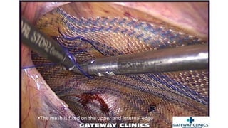 •The mesh is fixed on the upper and internal edge
 