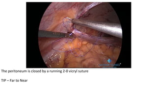The peritoneum is closed by a running 2-0 vicryl suture
TIP – Far to Near
 