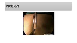 INCISION
 
