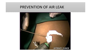 PREVENTION OF AIR LEAK
 