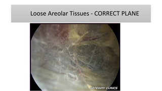 Loose Areolar Tissues - CORRECT PLANE
 