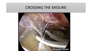 CROSSING THE MIDLINE
 