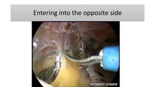 Entering into the opposite side
 