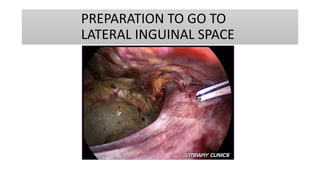 PREPARATION TO GO TO
LATERAL INGUINAL SPACE
 