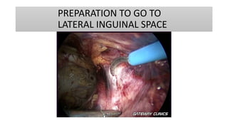 PREPARATION TO GO TO
LATERAL INGUINAL SPACE
 