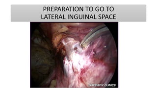 PREPARATION TO GO TO
LATERAL INGUINAL SPACE
 