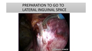 PREPARATION TO GO TO
LATERAL INGUINAL SPACE
 
