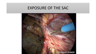 EXPOSURE OF THE SAC
 
