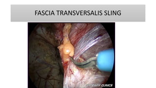 FASCIA TRANSVERSALIS SLING
 