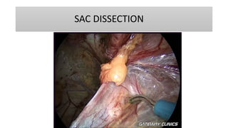 SAC DISSECTION
 