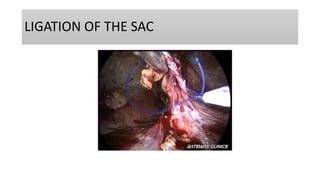 LIGATION OF THE SAC
 