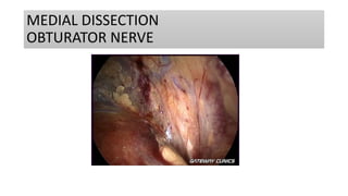 MEDIAL DISSECTION
OBTURATOR NERVE
 