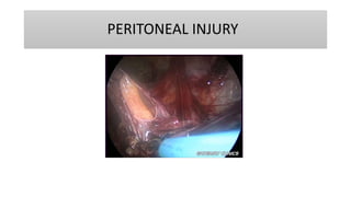 PERITONEAL INJURY
 