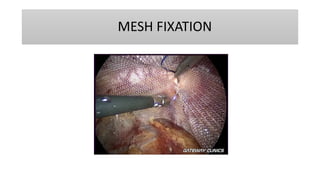 MESH FIXATION
 