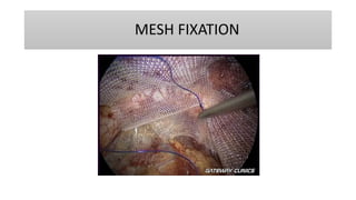 MESH FIXATION
 