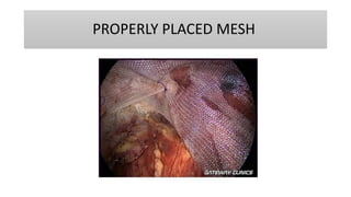 PROPERLY PLACED MESH
 