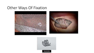 Other Ways Of Fixation
TACKERS
 