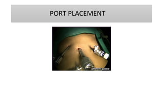 PORT PLACEMENT
 