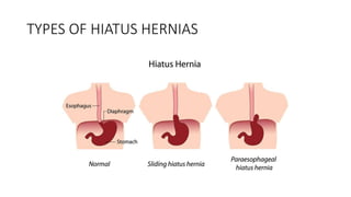 TYPES OF HIATUS HERNIAS
 