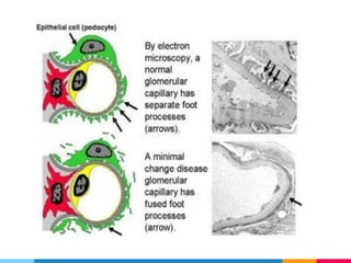 Nephrocity Biochemistry of Nephrotic Syndrome | PPTX