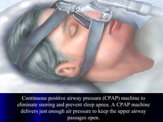 Continuous positive airway pressure (CPAP) machine to
eliminate snoring and prevent sleep apnea. A CPAP machine
delivers just enough air pressure to keep the upper airway
passages open.
 