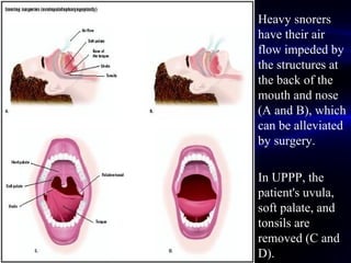 Heavy snorers
have their air
flow impeded by
the structures at
the back of the
mouth and nose
(A and B), which
can be alleviated
by surgery.
In UPPP, the
patient's uvula,
soft palate, and
tonsils are
removed (C and
D).
 