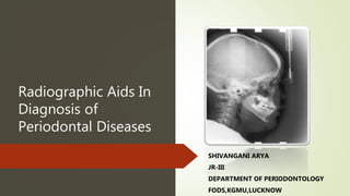 Radiographic Aids In
Diagnosis of
Periodontal Diseases
SHIVANGANI ARYA
JR-III
DEPARTMENT OF PERIODONTOLOGY
FODS,KGMU,LUCKNOW
 