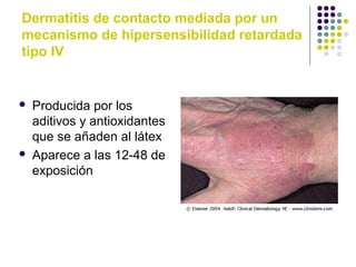 Dermatitis de contacto mediada por un
mecanismo de hipersensibilidad retardada
tipo IV
 Producida por los
aditivos y antioxidantes
que se añaden al látex
 Aparece a las 12-48 de
exposición
 