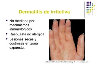 Dermatitis de irritativa
 No mediada por
mecanismos
inmunológicos
 Respuesta no alérgica
 Lesiones secas y
costrosas en zona
expuesta.
 