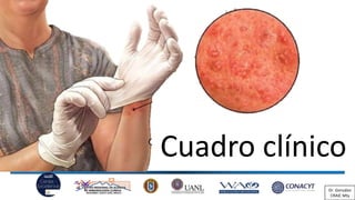 Cuadro clínico
Dr. González
CRAIC Mty
 