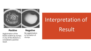 Interpretation of
Result
Positive Negative
Agglutination of the
beads evident by clumps
in any of the dilutions is
considered a positive
result.
No agglutination
or formation of
clumps.
 
