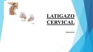 LATIGAZO
CERVICAL
Esguince cervical
 